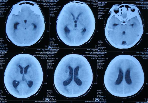 结核性脑积水,脑膜炎脑积水要治疗多久