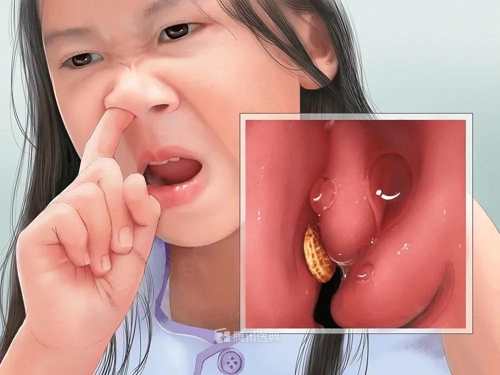 娃一天流3次鼻血,用纸巾堵住后竟吐血!这些止血法太坑娃