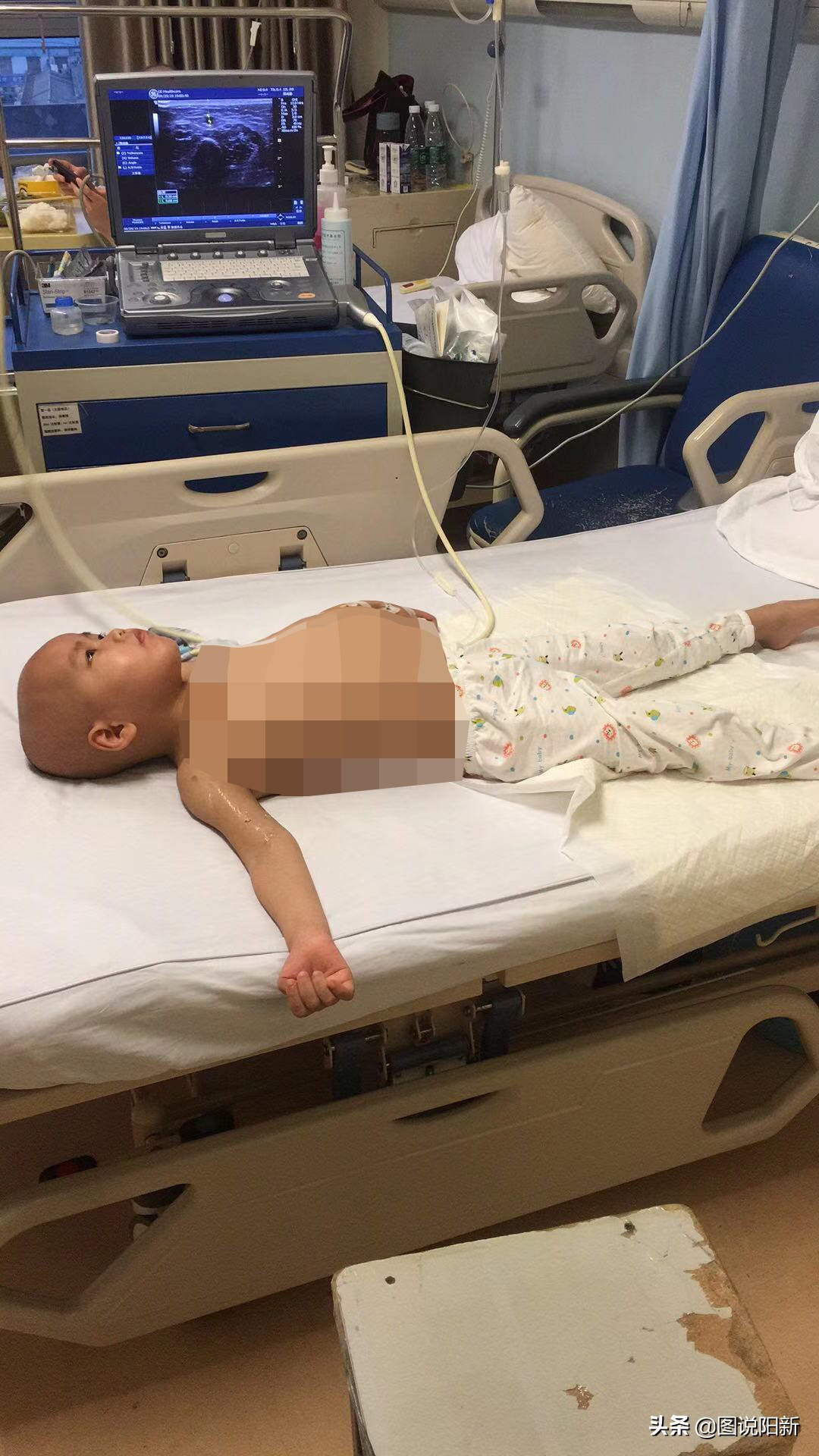 肿瘤儿童化疗期间脑萎缩,化疗后脑萎缩变傻了