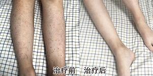 过敏性紫癜肾炎能根治吗？来看一下这个10岁小朋友的案例