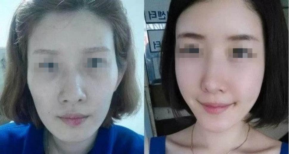 太阳穴凹陷自体脂肪填充怎么样,太阳穴凹陷显凶吗