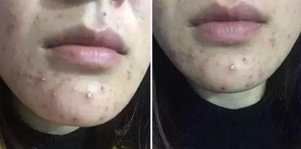 口罩皮炎,戴口罩会导致口周皮炎吗