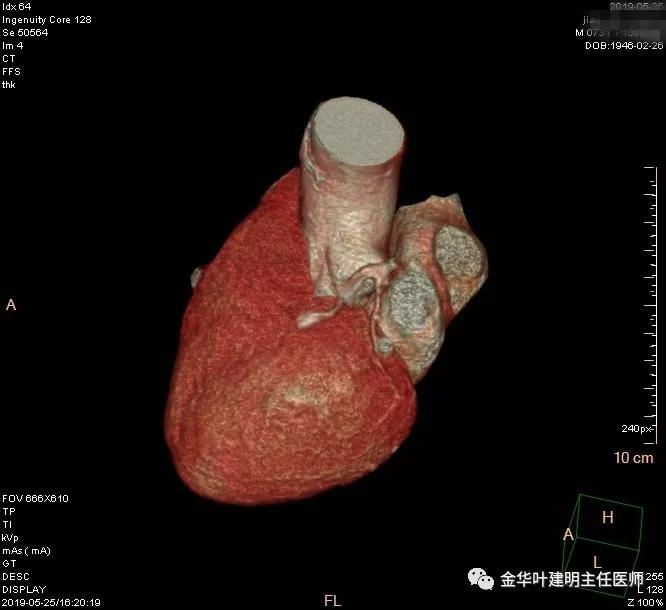 手术引起乳糜胸,有没有做了肺结节手术后是误诊的