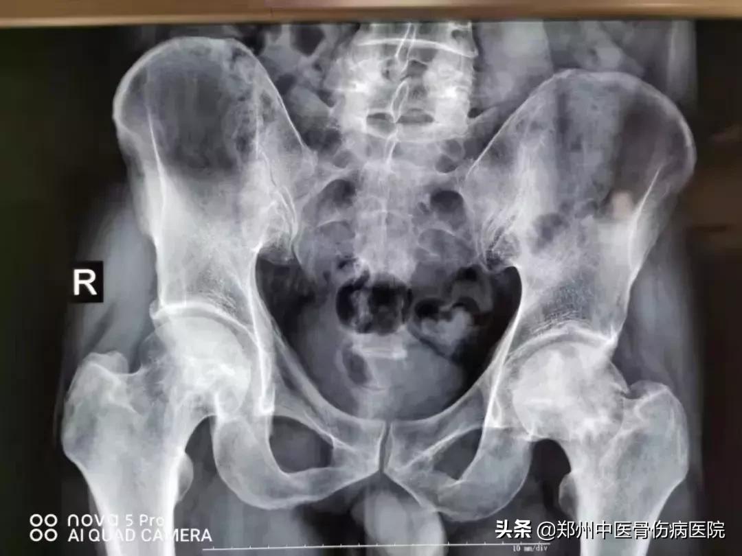 股骨头坏死骨盆旋转手法怎么做,股骨头不愈合康复锻炼方法