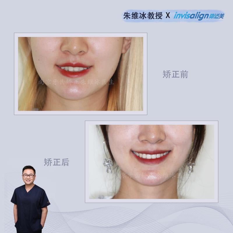 牙齿重度拥挤不拔牙正畸成功案例,南京牙齿矫正舌侧