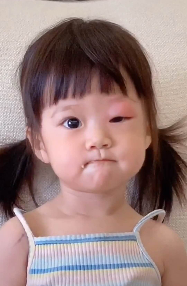 被蚊子叮眼睛的宝宝视频,萌娃被蚊子咬成大耳朵图图