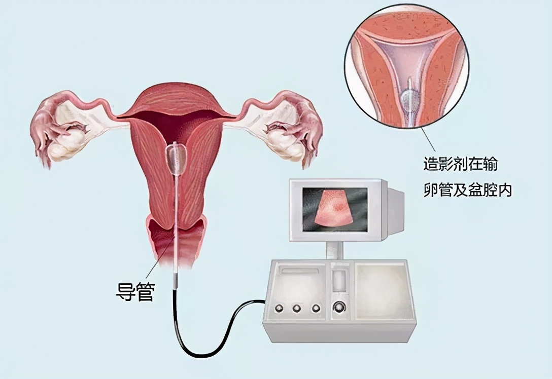 女性得了结核,女性有结核能做试管吗