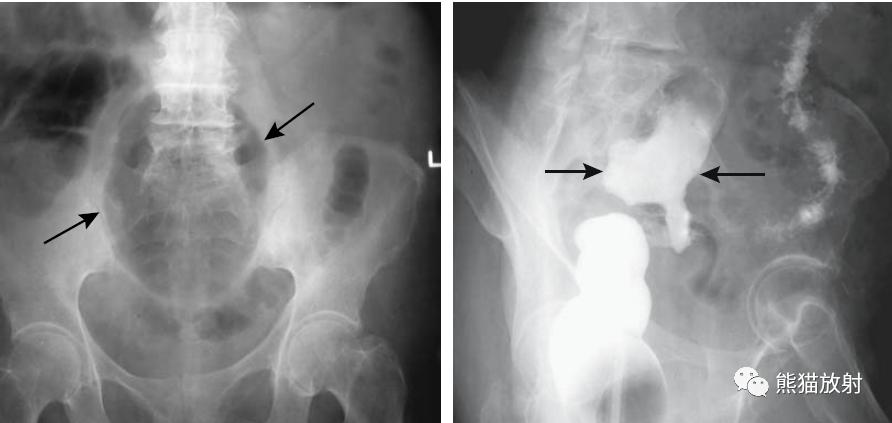 腹部影像图片大全,乙状直肠疼痛位置图片