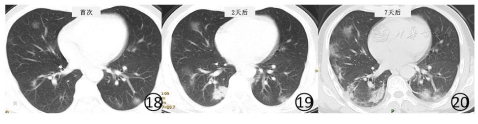 磨玻璃阴影怎么处理,磨玻璃阴影