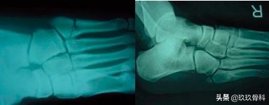 陈旧性踝关节损伤的治疗,踝关节损伤现场处理视频