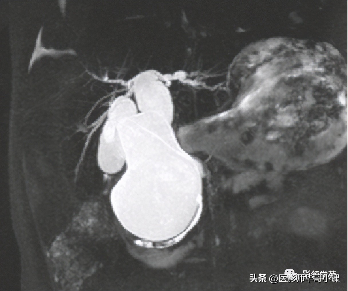 胆总管变异,胆胰管解剖