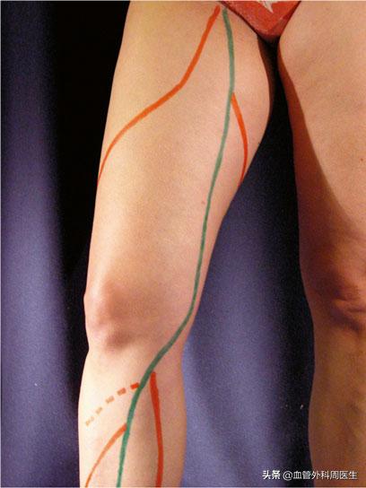 你了解静脉曲张吗,下肢静脉曲张常识