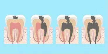 想要孩子牙齿好只用学会这几招,别让孩子颜值败在一口坏牙