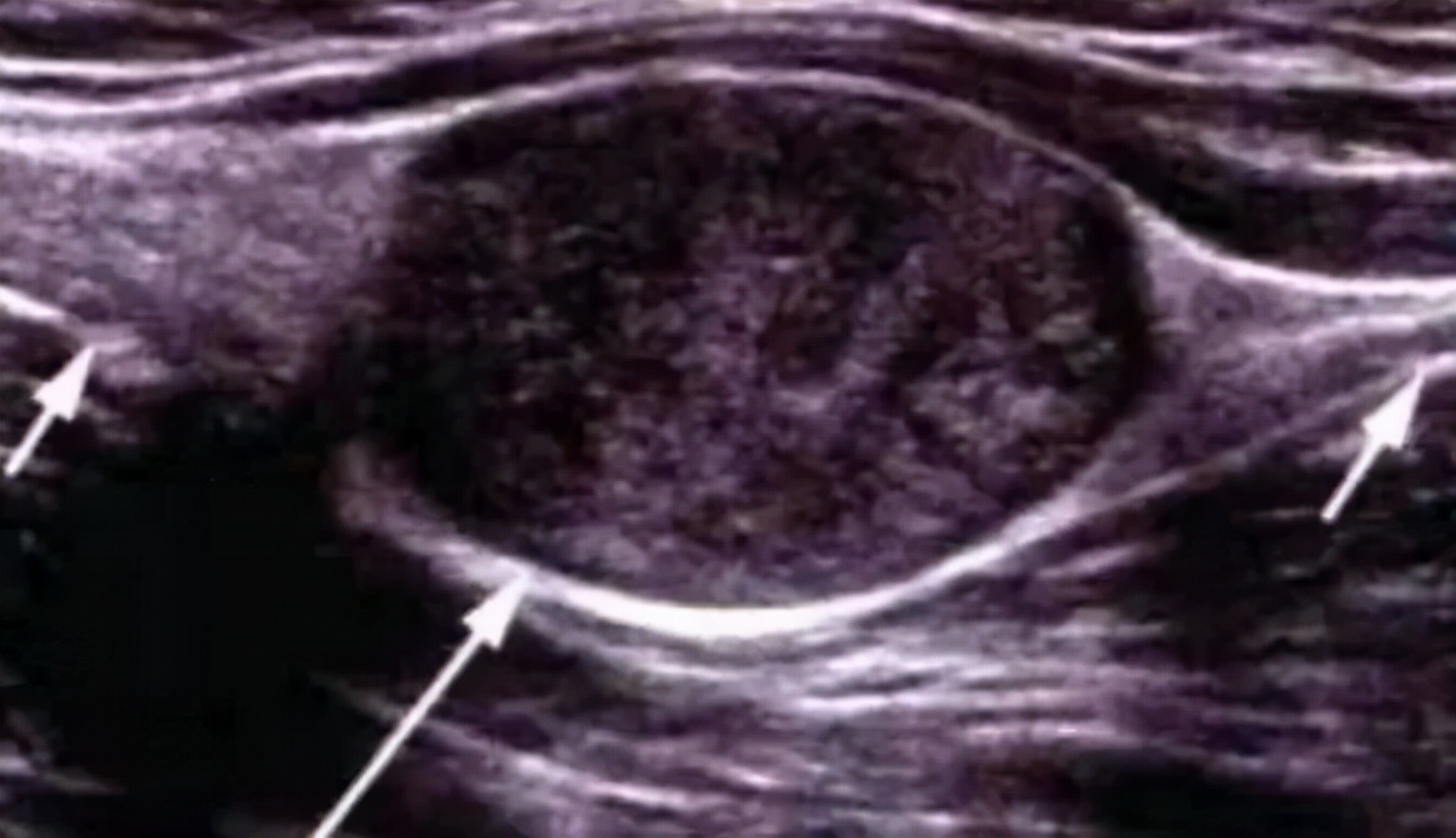 手麻肌电图检查过程视频,手麻脚麻肌电图正常
