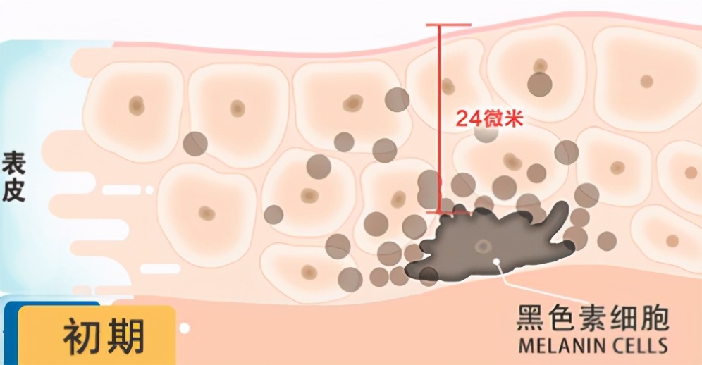 青褐斑激光治疗后颜色会加深吗,激光可以淡化褐斑吗