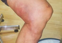 下肢静脉曲张血栓性静脉炎的症状,静脉曲张怎么会引起血栓性静脉炎