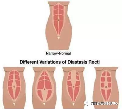 腹直肌分离中医有什么可靠疗法,腹直肌分离能做扩胸运动吗