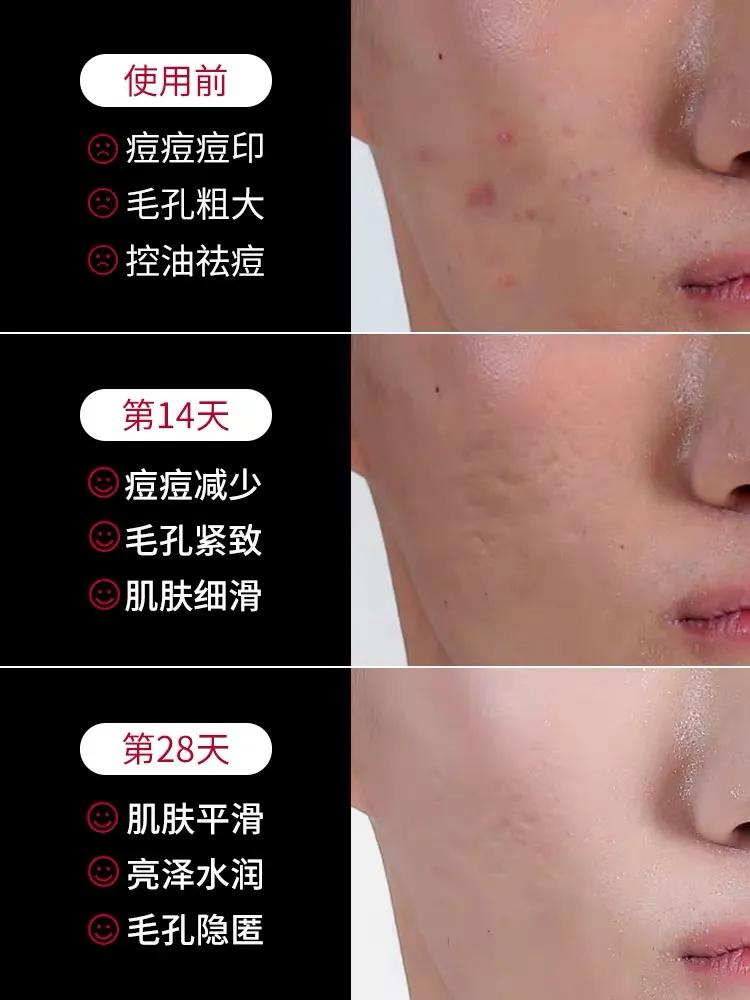 男生如何祛痘有效简单方法,男生如何祛痘和皮肤变白