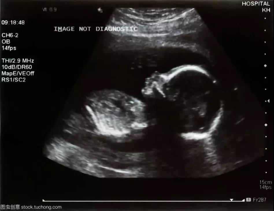 四维超声和二维b超的区别,产检b超比前两次小