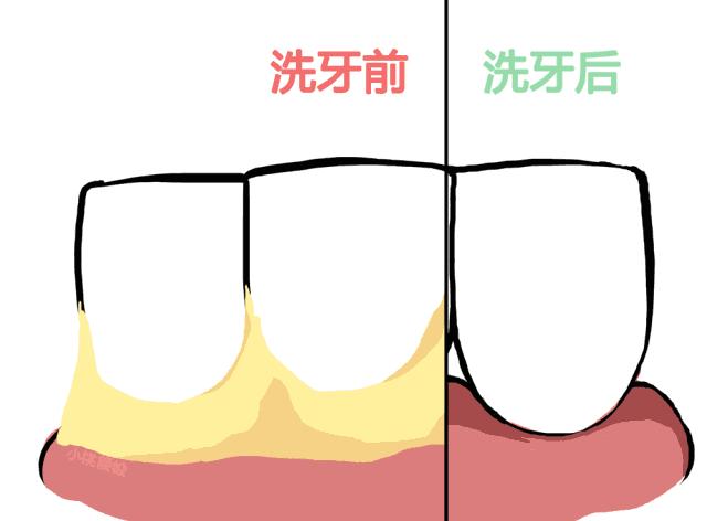 智齿蛀牙痛有什么有效方法止痛,智齿旁边牙松动蛀牙如何处理
