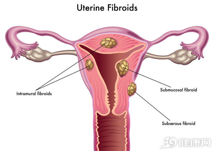 辟谣｜上了环的女性，更容易患子宫肌瘤？妇科专家权威解答