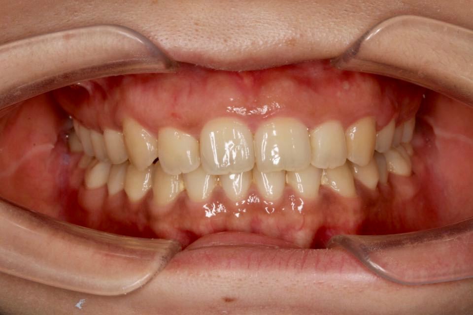 西安张军正畸医生如何,西安牙齿矫正案例