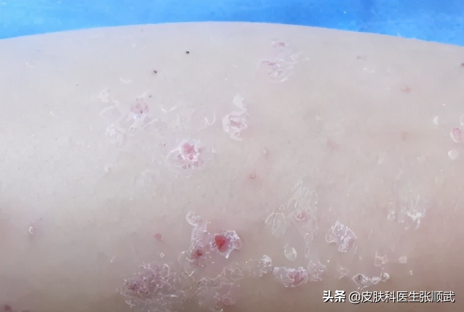 得了银屑病用什么药膏才能好,得了银屑病要预防什么