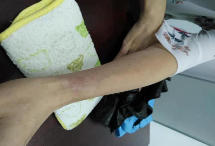 日光性皮炎用复方薄荷脑软膏,过敏性皮炎擦红霉素软膏