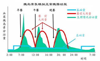 闭环胰岛素泵有哪些,糖尿病自动胰岛素泵