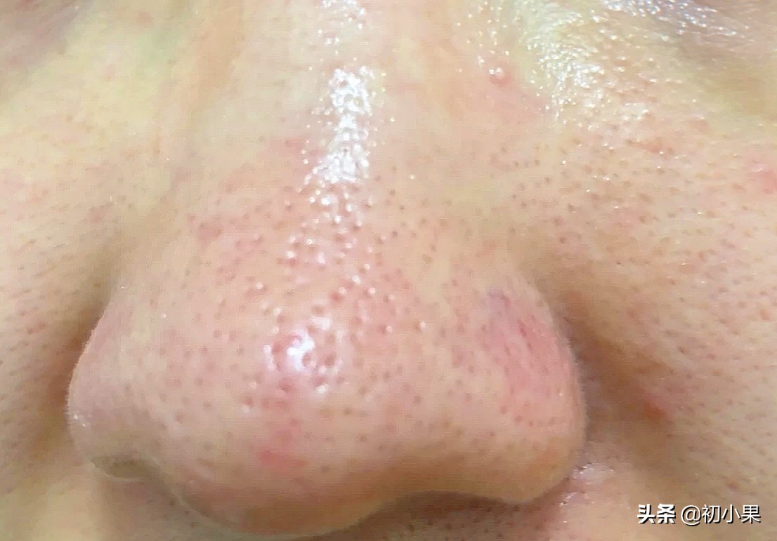 鼻子上的黑头怎么去除,鼻子上的黑头怎么去除小孩