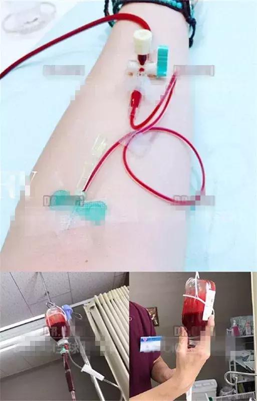 减肥出大事！用了网上爆红的方法，23岁姑娘紧急“换肝”捡回一条命