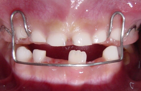 儿童牙齿换牙顺序图双排牙,小朋友如何预防双排牙医生来支招