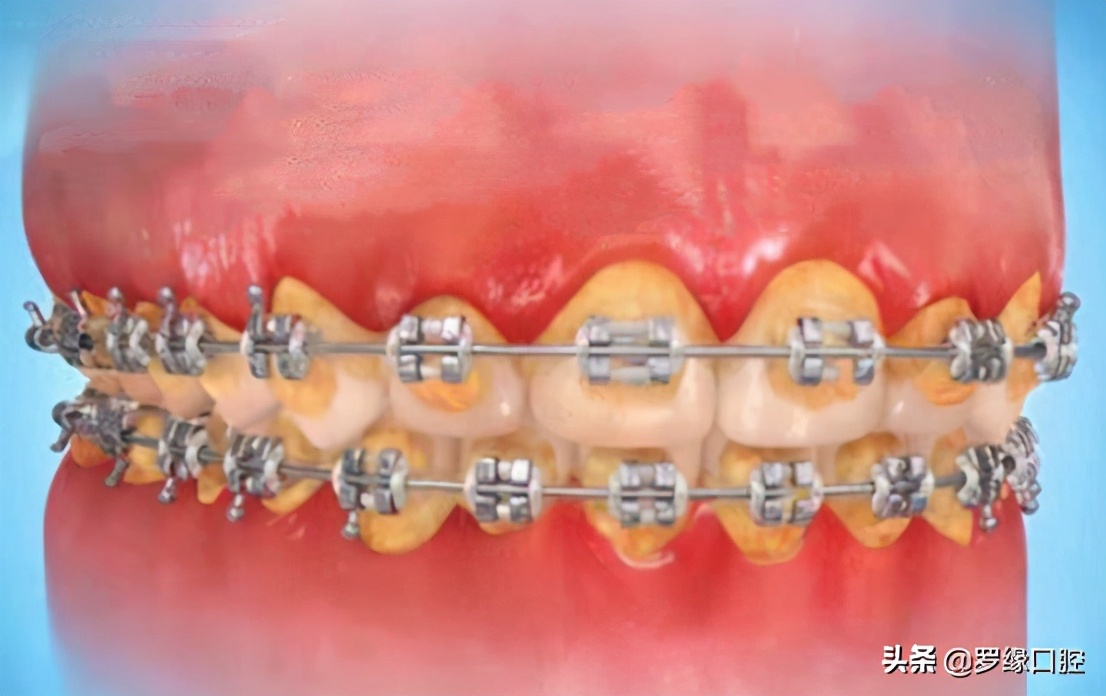 牙齿矫正后变黄怎么处理,矫正牙齿后牙齿为什么变黄了