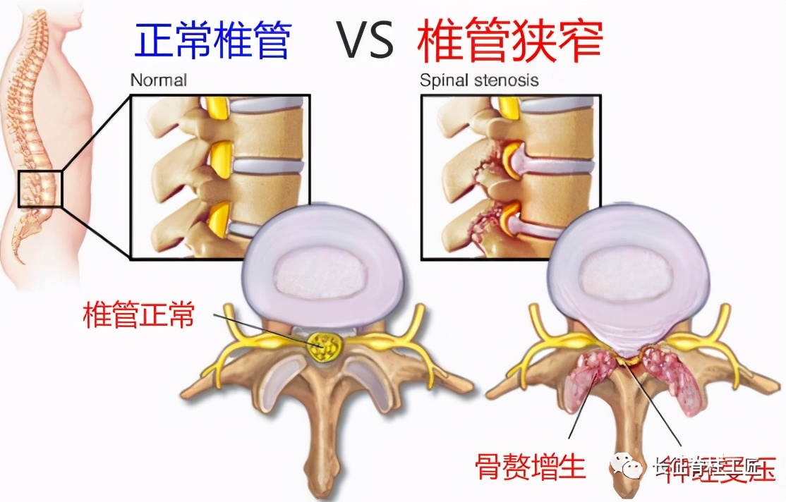 老年人腰椎管狭窄可以微创手术吗,老年人腰椎管狭窄瘫痪