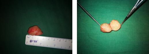 锁骨下方有个鸡蛋大小的肿物,锁骨下面长了一个硬东西是什么