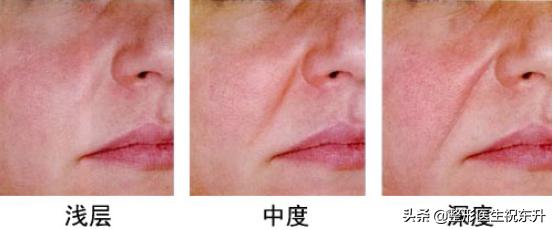 脸上的法令纹怎么去除,脸上有法令纹去除最好的方法