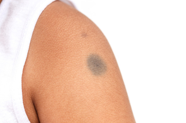 婴儿为什么有胎记,婴儿胎记大全图解