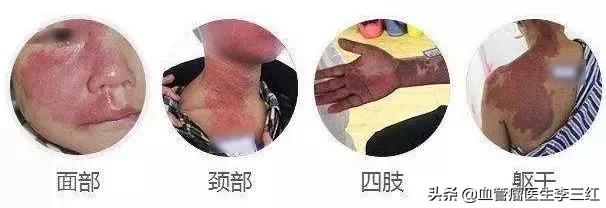 以为是胎记检查是血管瘤要紧吗,有些宝宝有胎记是什么原因造成的