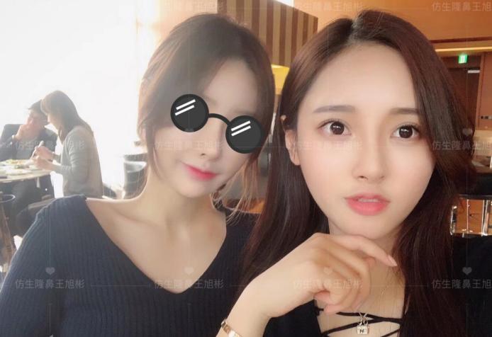 线雕隆鼻后鼻综合修复术,隆鼻失败修复手术真实案例