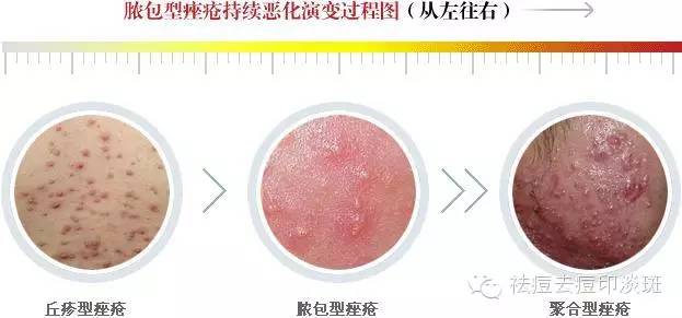 中医脸上长很多脓包型痘痘的原因,脸上长炎症痘痘怎么回事