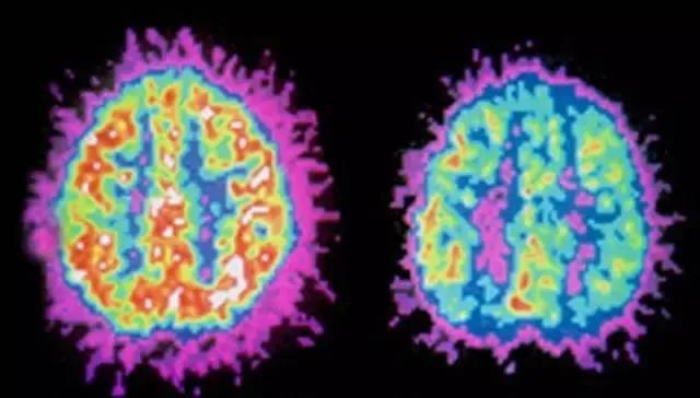 屡教不改的多动症娃，原来是大脑出了问题！这样治最有效