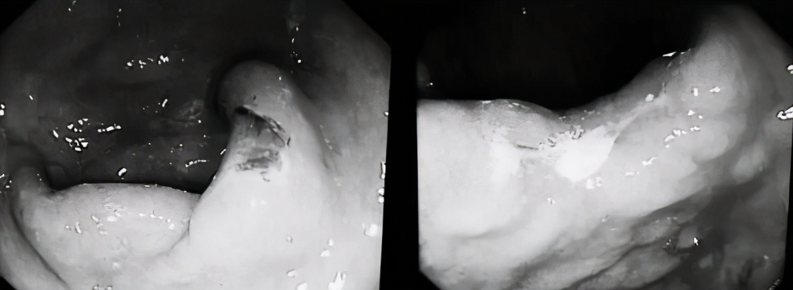 中山医院治带状疱疹,中山带状疱疹