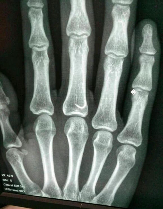 草鱼受伤怎么恢复,10斤草鱼手指受伤