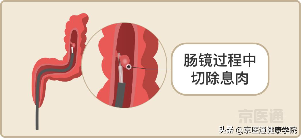升结肠0.4息肉是癌的可能性是多少,胃体多发息肉0.2-0.4是癌吗