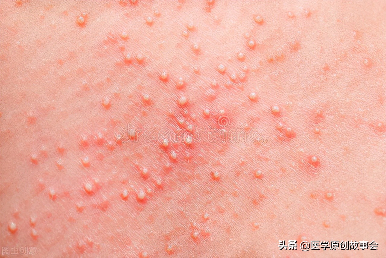 皮肤长了个凸起的小肉球怎么去除,皮肤表面长出小肉球是什么原因呢