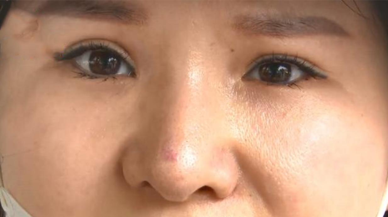 打个喷嚏鼻子假体掉出来了,打了个喷嚏堵在鼻子里了