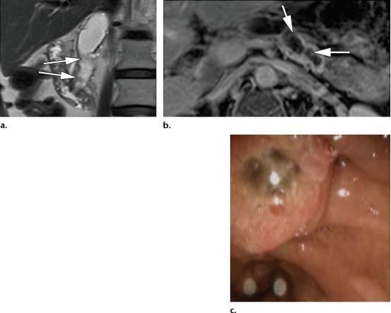 急性胰腺炎和慢性胰腺有什么症状,胰腺炎合并胰腺肿物