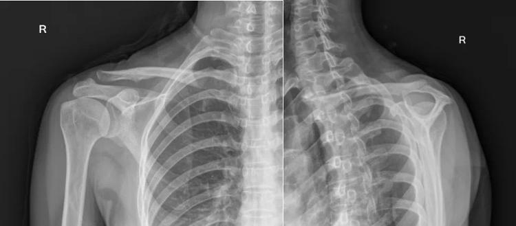 潍坊哪个医院看肩周炎比较好,潍坊中医院颈肩腰腿疼专家