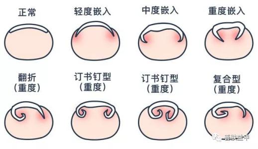 甲沟炎症状怎么治,甲沟炎是怎么引起的治疗方法