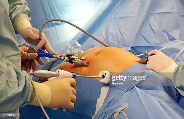 割个阑尾被当堕胎？现代腹腔镜手术先驱的棺材板要压不住了